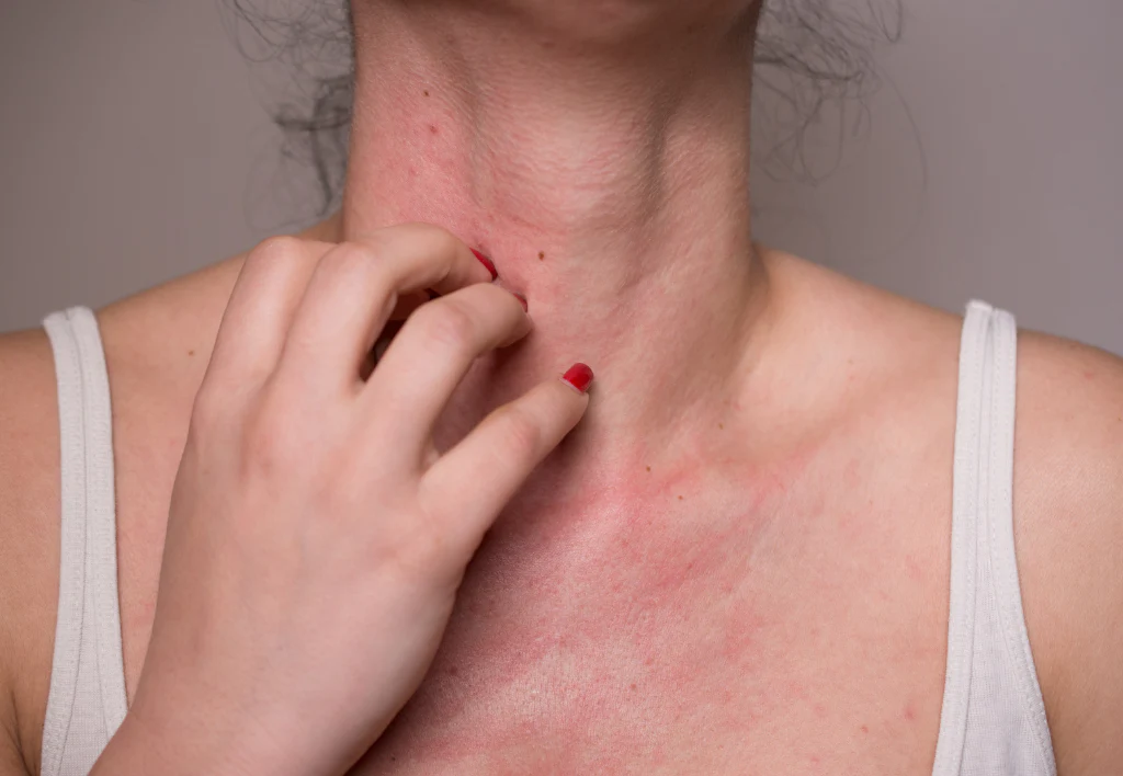 allergies des produits issus d’insectes 
